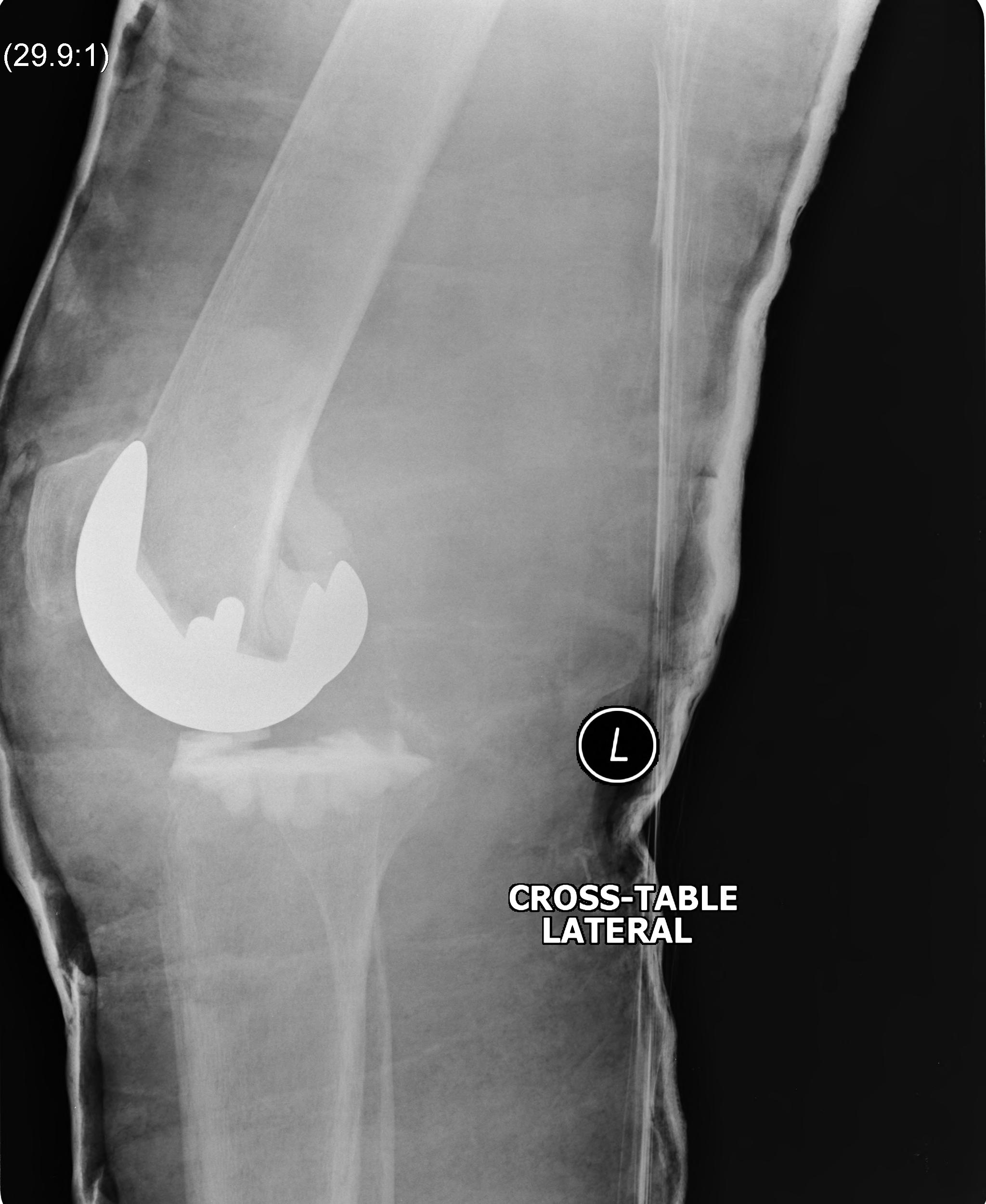 TKR Dislocation Lateral